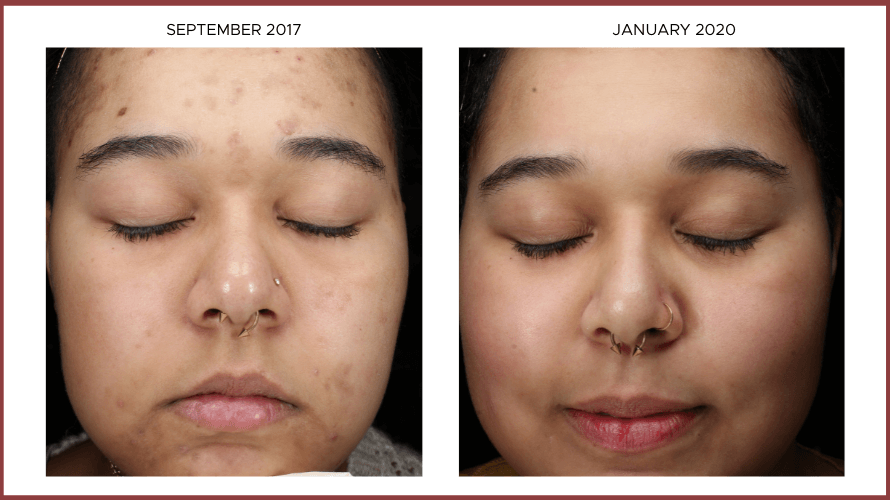 Before After Study Photos